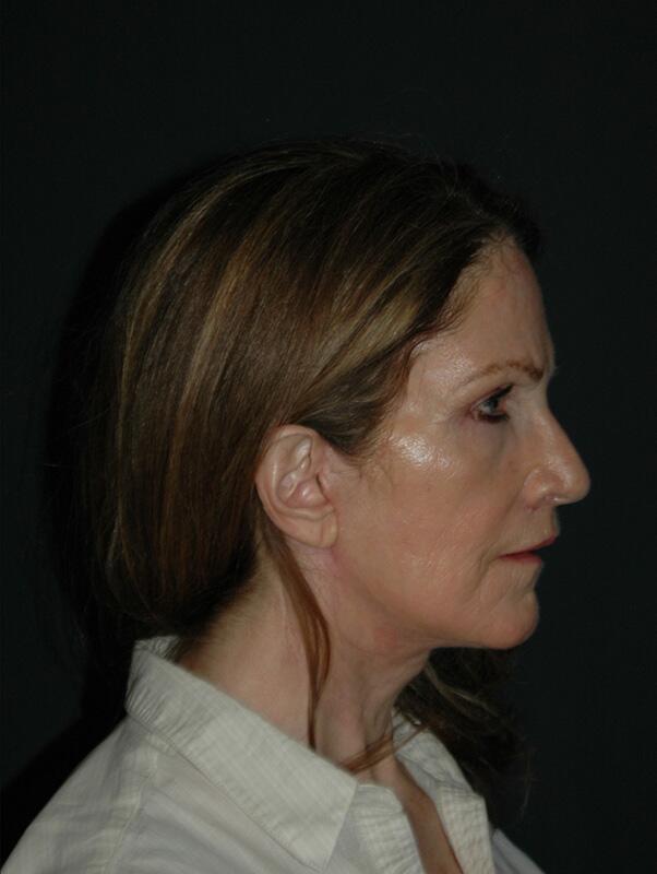 Facelift & Neck Lift Before & After Photo