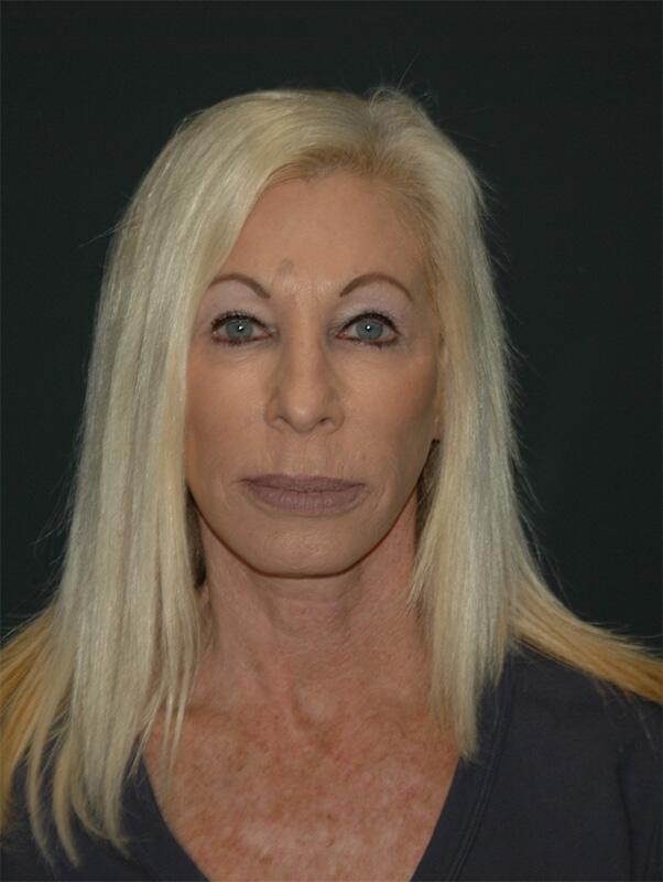 Facelift & Neck Lift Before & After Photo