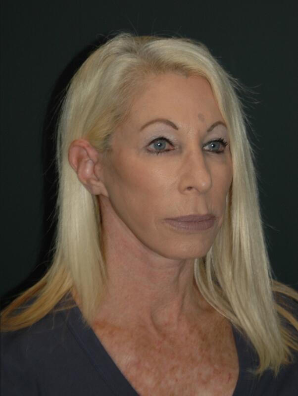 Facelift & Neck Lift Before & After Photo