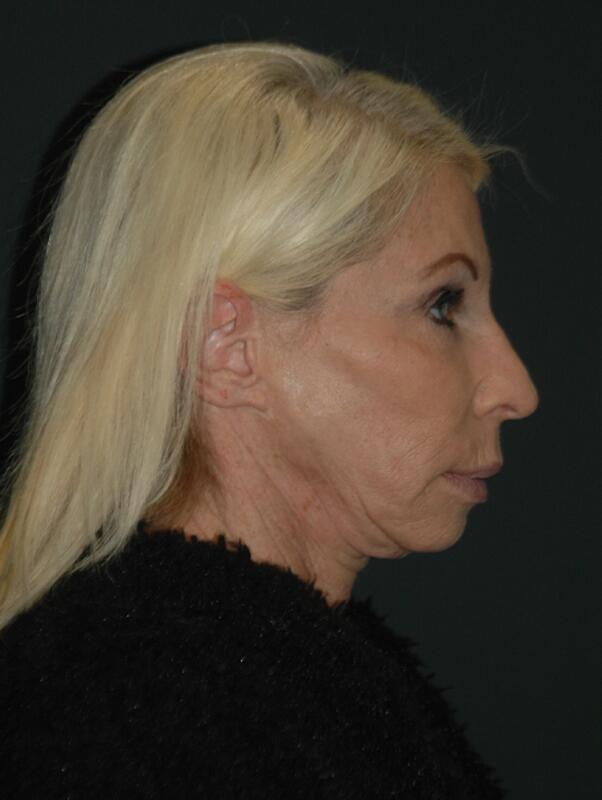 Facelift & Neck Lift Before & After Photo