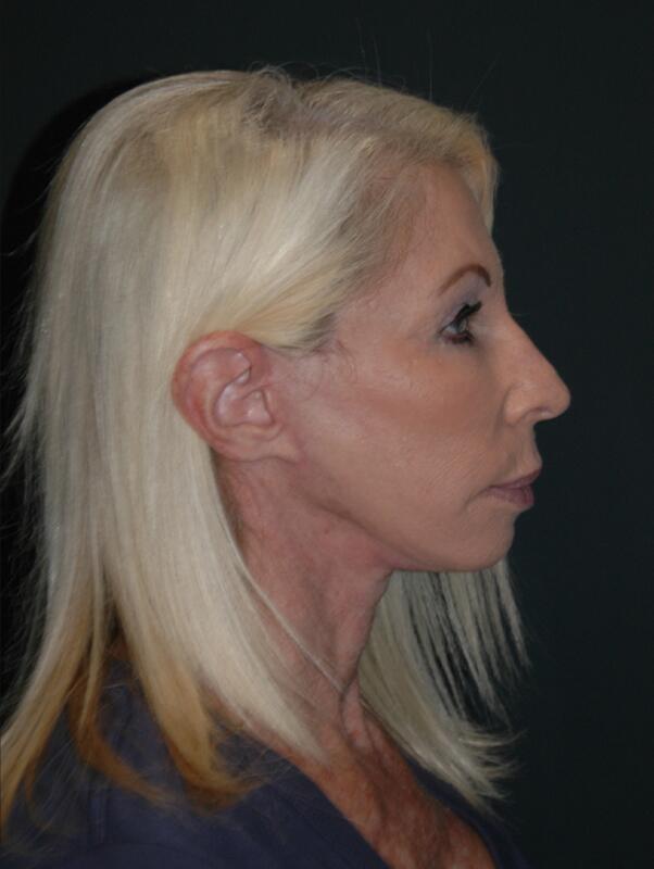 Facelift & Neck Lift Before & After Photo