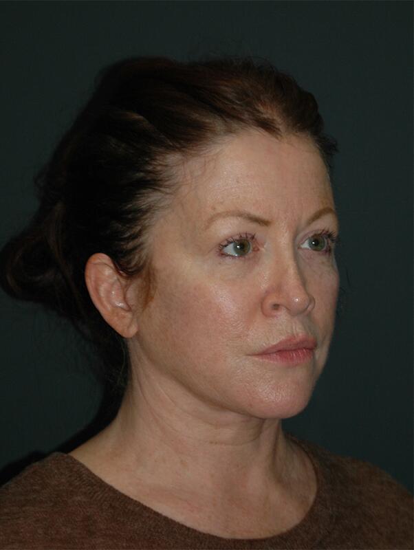 Facelift & Neck Lift Before & After Photo