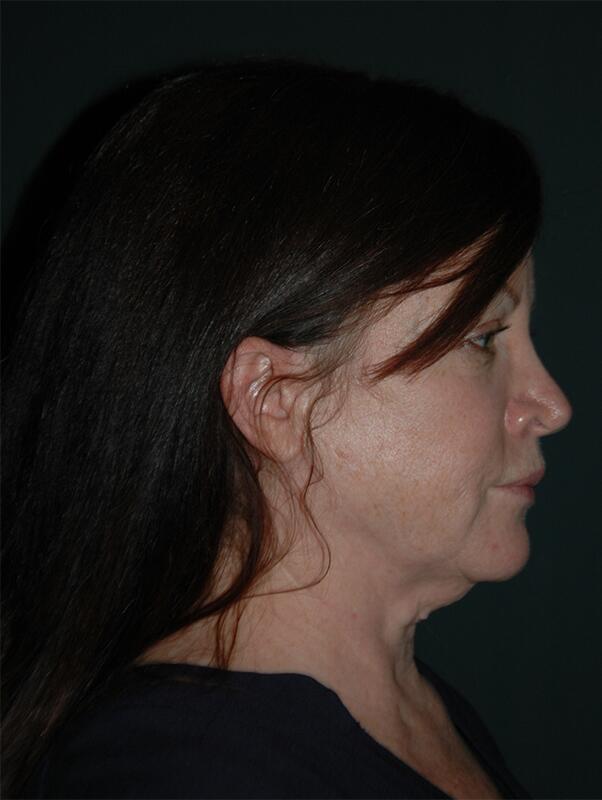 Facelift & Neck Lift Before & After Photo