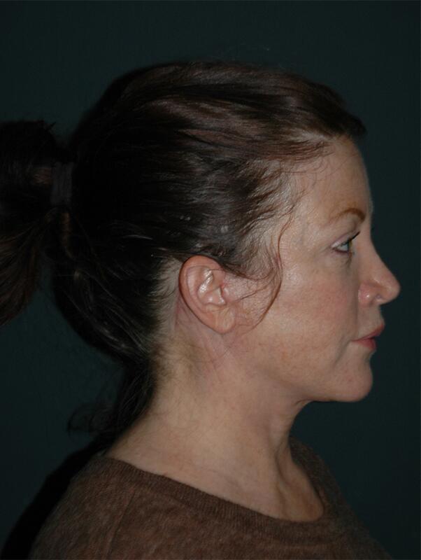 Facelift & Neck Lift Before & After Photo