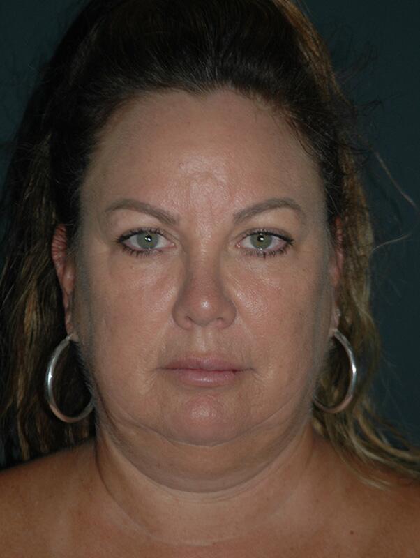 Facelift & Neck Lift Before & After Photo