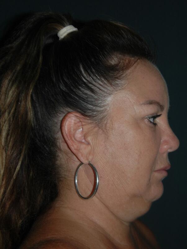 Facelift & Neck Lift Before & After Photo