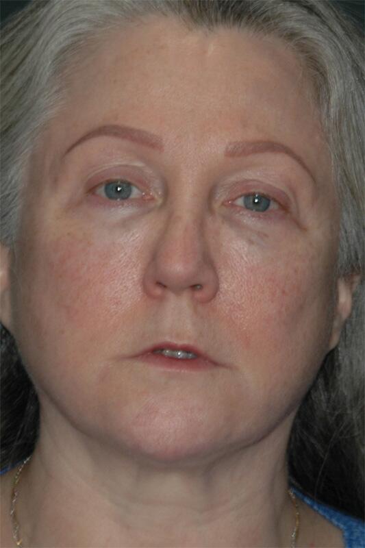 Facelift & Neck Lift Before & After Photo