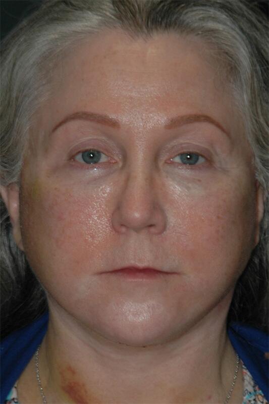 Facelift & Neck Lift Before & After Photo