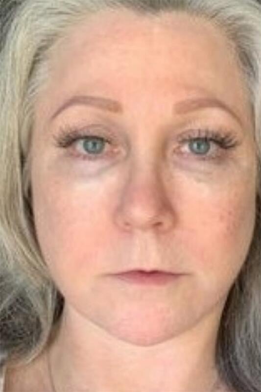 Facelift & Neck Lift Before & After Photo