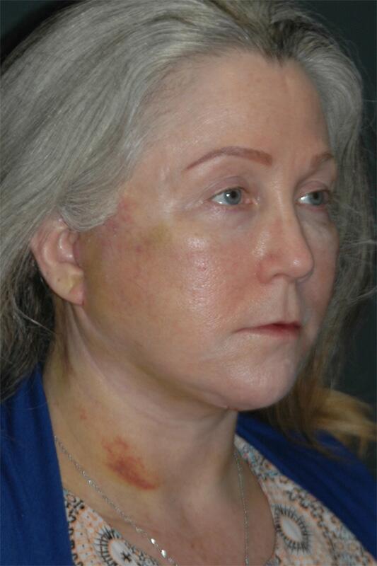 Facelift & Neck Lift Before & After Photo