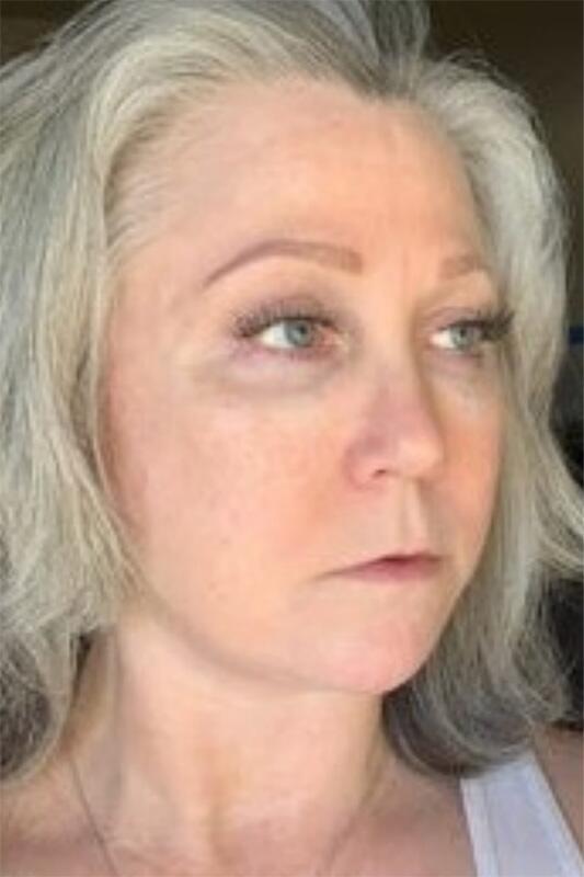 Facelift & Neck Lift Before & After Photo