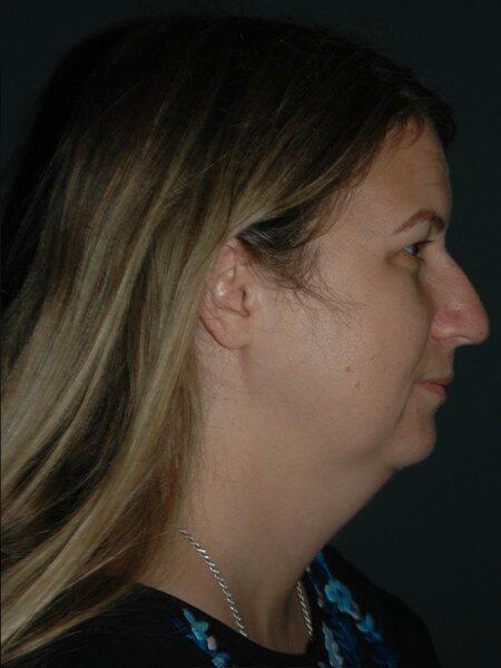 Facelift & Neck Lift Before & After Photo