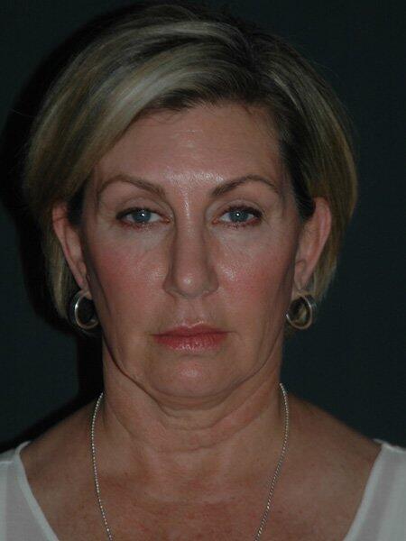 Facelift & Neck Lift Before & After Photo