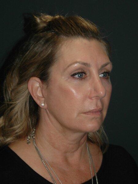 Facelift & Neck Lift Before & After Photo