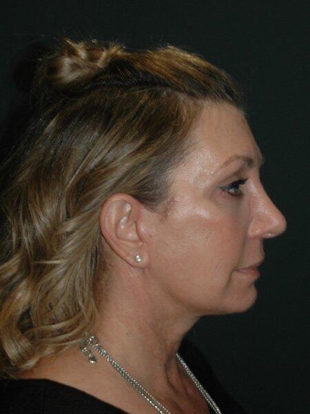 Facelift & Neck Lift Before & After Photo