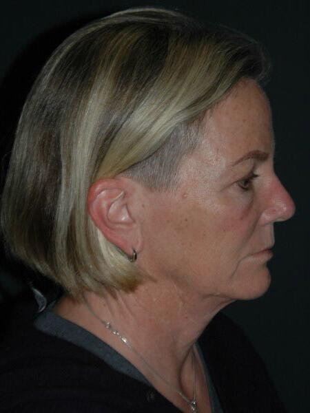 Facelift & Neck Lift Before & After Photo