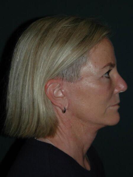 Facelift & Neck Lift Before & After Photo