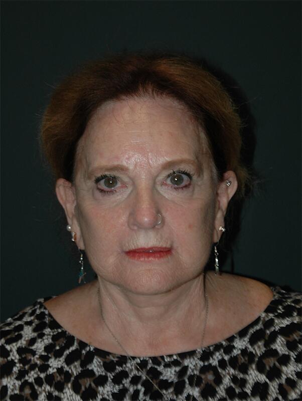 Facelift & Neck Lift Before & After Photo