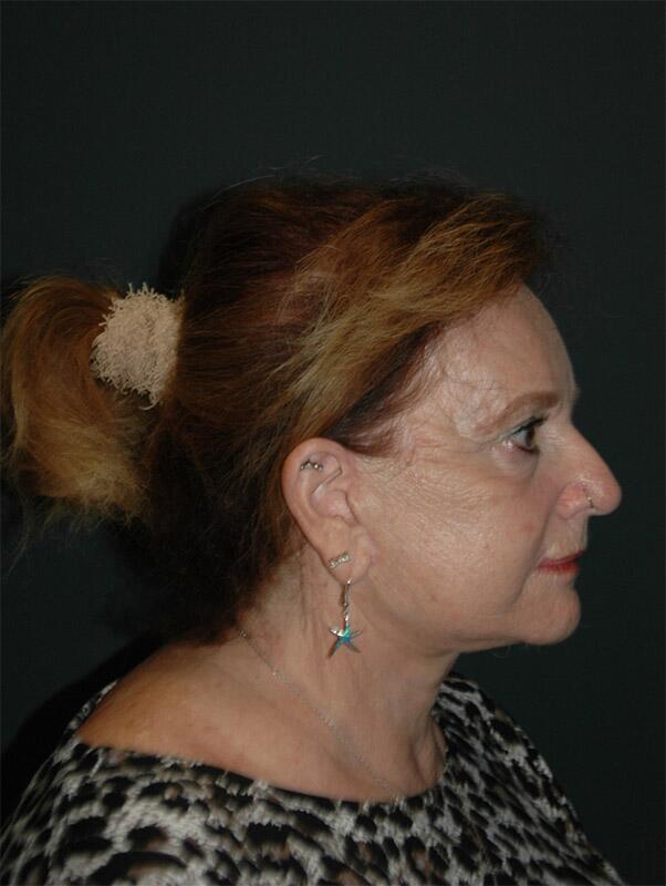 Facelift & Neck Lift Before & After Photo