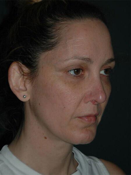 Facelift & Neck Lift Before & After Photo