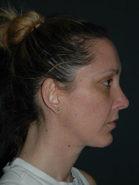 Facelift & Neck Lift Before & After Photo