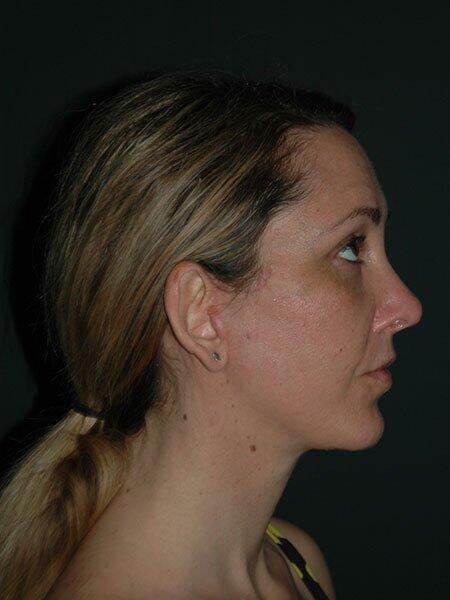 Facelift & Neck Lift Before & After Photo