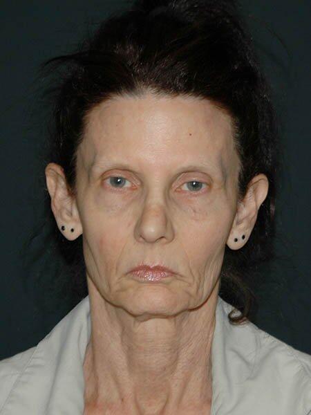 Facelift & Neck Lift Before & After Photo