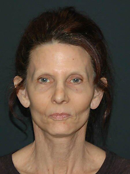 Facelift & Neck Lift Before & After Photo