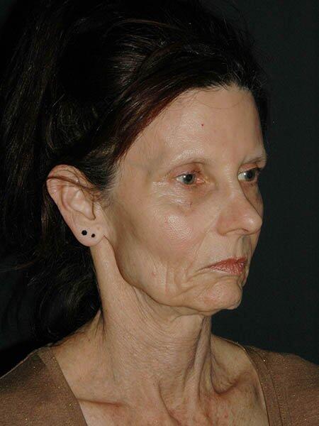 Facelift & Neck Lift Before & After Photo