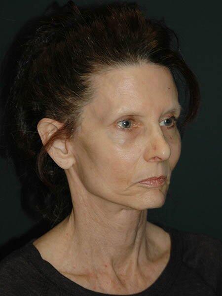 Facelift & Neck Lift Before & After Photo