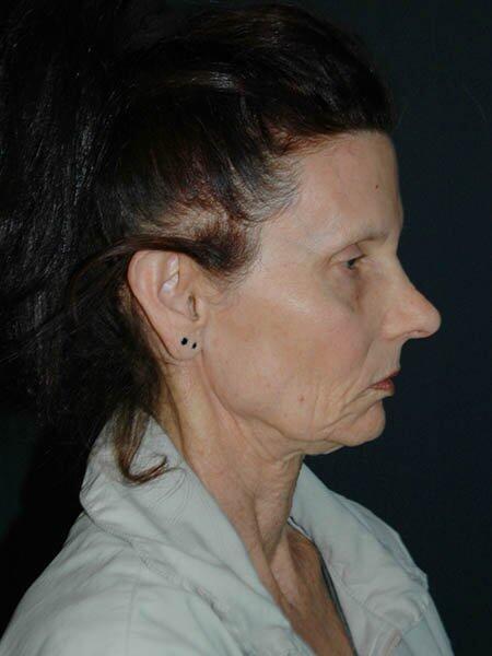 Facelift & Neck Lift Before & After Photo