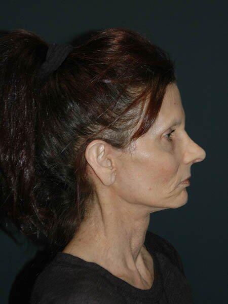 Facelift & Neck Lift Before & After Photo