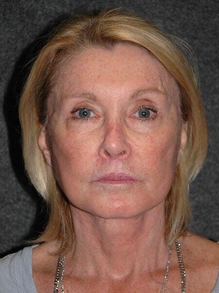 Facelift & Neck Lift Before & After Photo