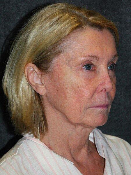 Facelift & Neck Lift Before & After Photo