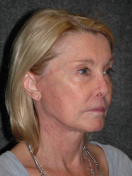 Facelift & Neck Lift Before & After Photo