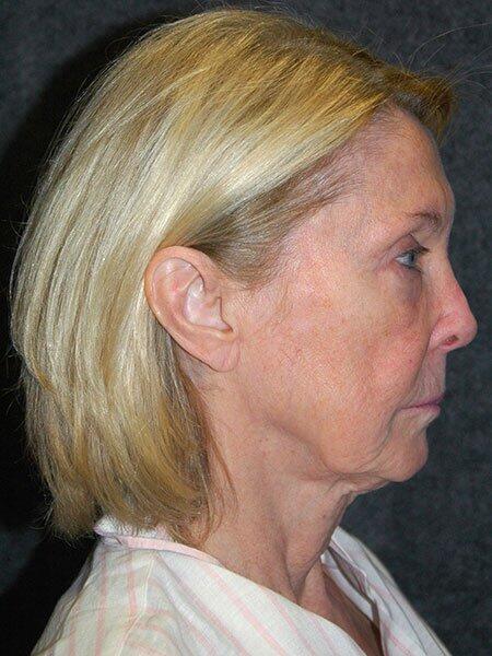 Facelift & Neck Lift Before & After Photo