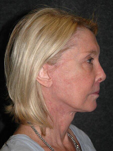 Facelift & Neck Lift Before & After Photo