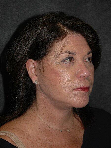 Facelift & Neck Lift Before & After Photo