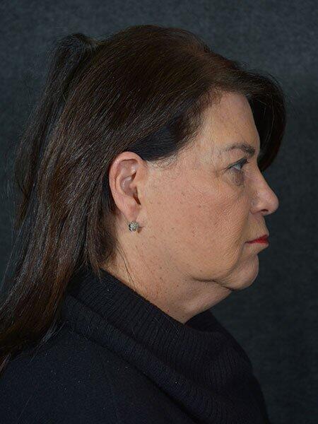 Facelift & Neck Lift Before & After Photo