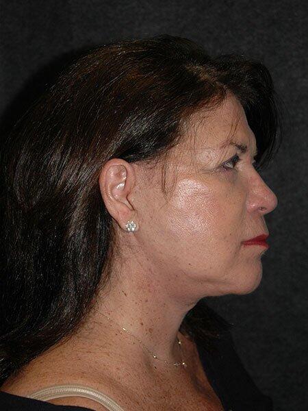 Facelift & Neck Lift Before & After Photo