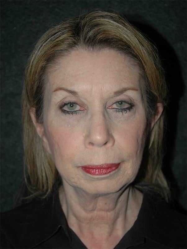 Facelift & Neck Lift Before & After Photo