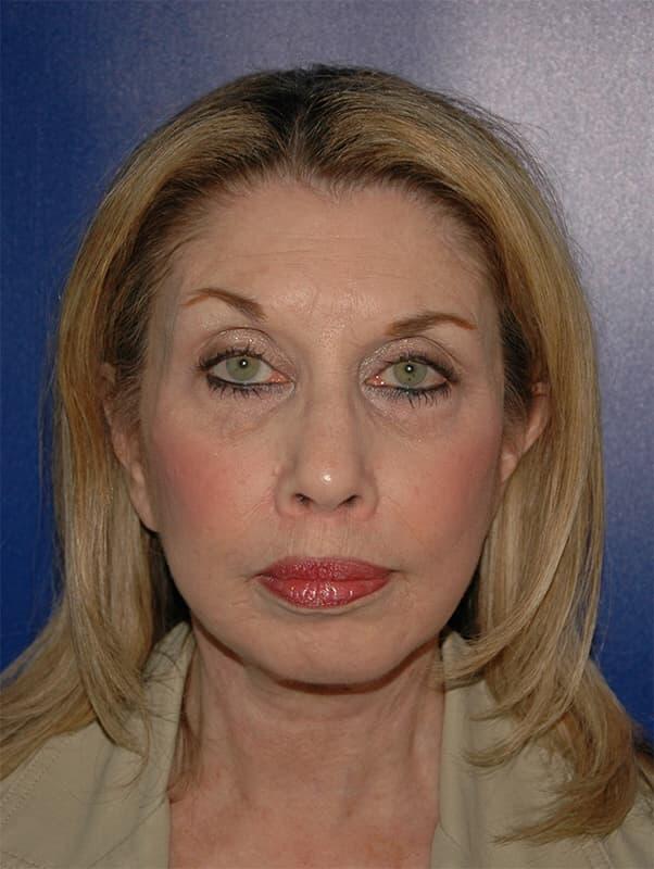 Facelift & Neck Lift Before & After Photo