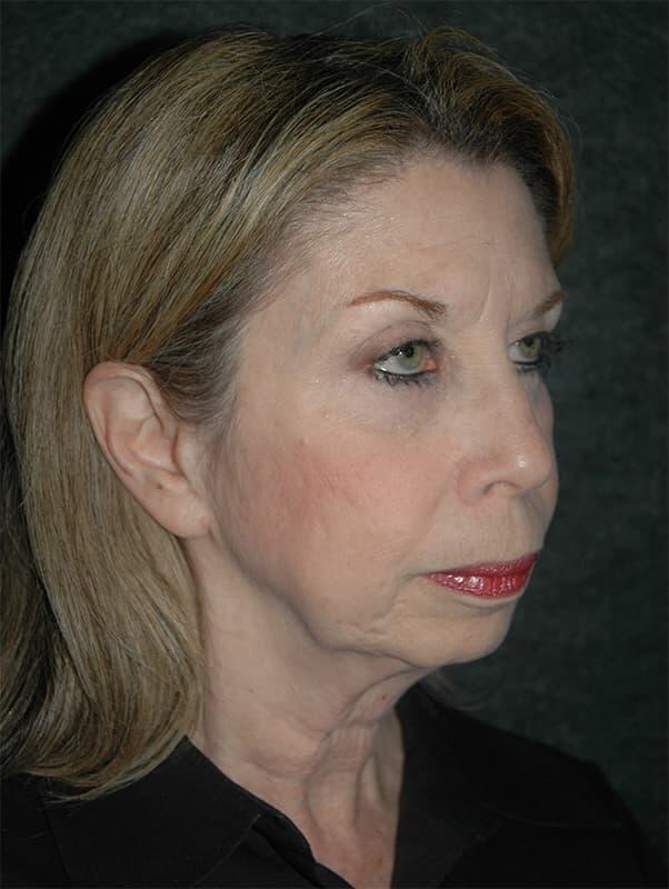 Facelift & Neck Lift Before & After Photo