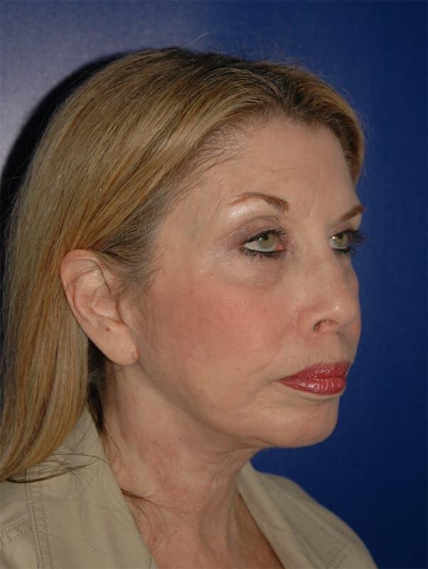 Facelift & Neck Lift Before & After Photo