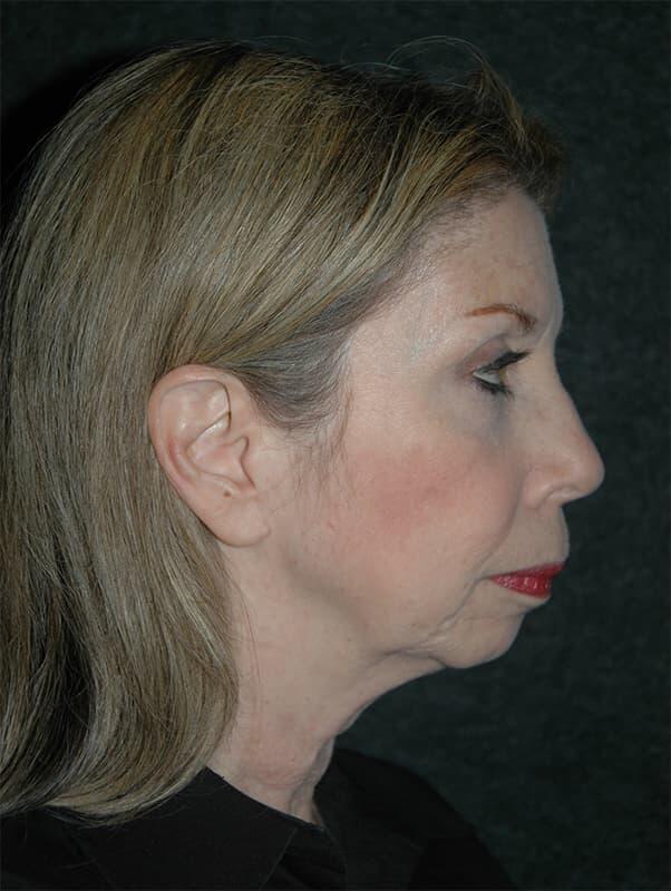 Facelift & Neck Lift Before & After Photo