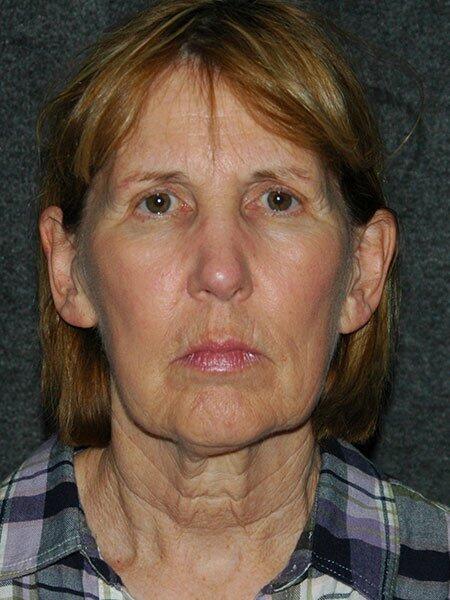 Facelift & Neck Lift Before & After Photo