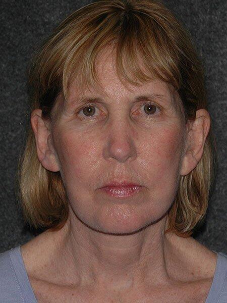 Facelift & Neck Lift Before & After Photo