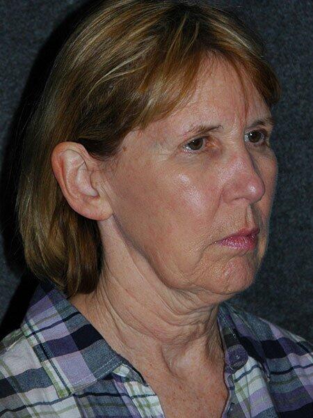 Facelift & Neck Lift Before & After Photo