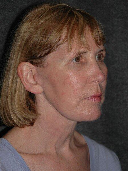 Facelift & Neck Lift Before & After Photo