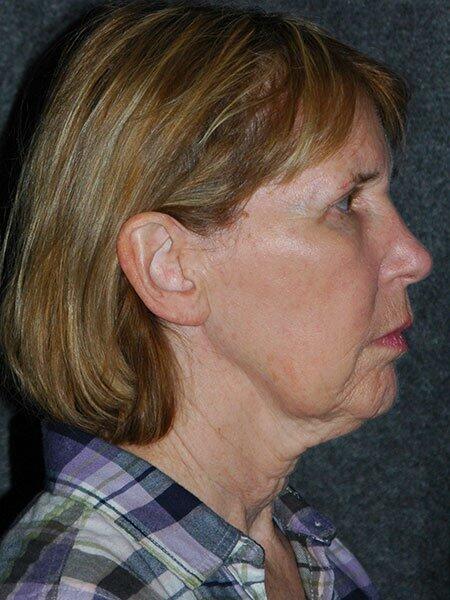 Facelift & Neck Lift Before & After Photo